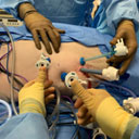 Laparoscopy